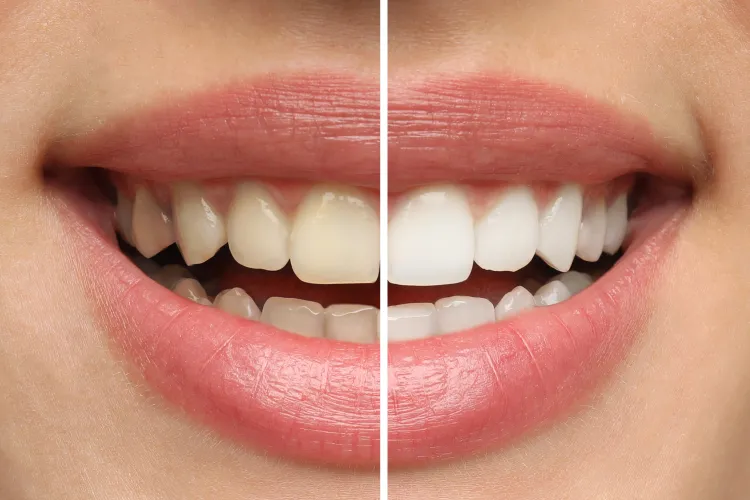 clareamento-dental-em-brasilia